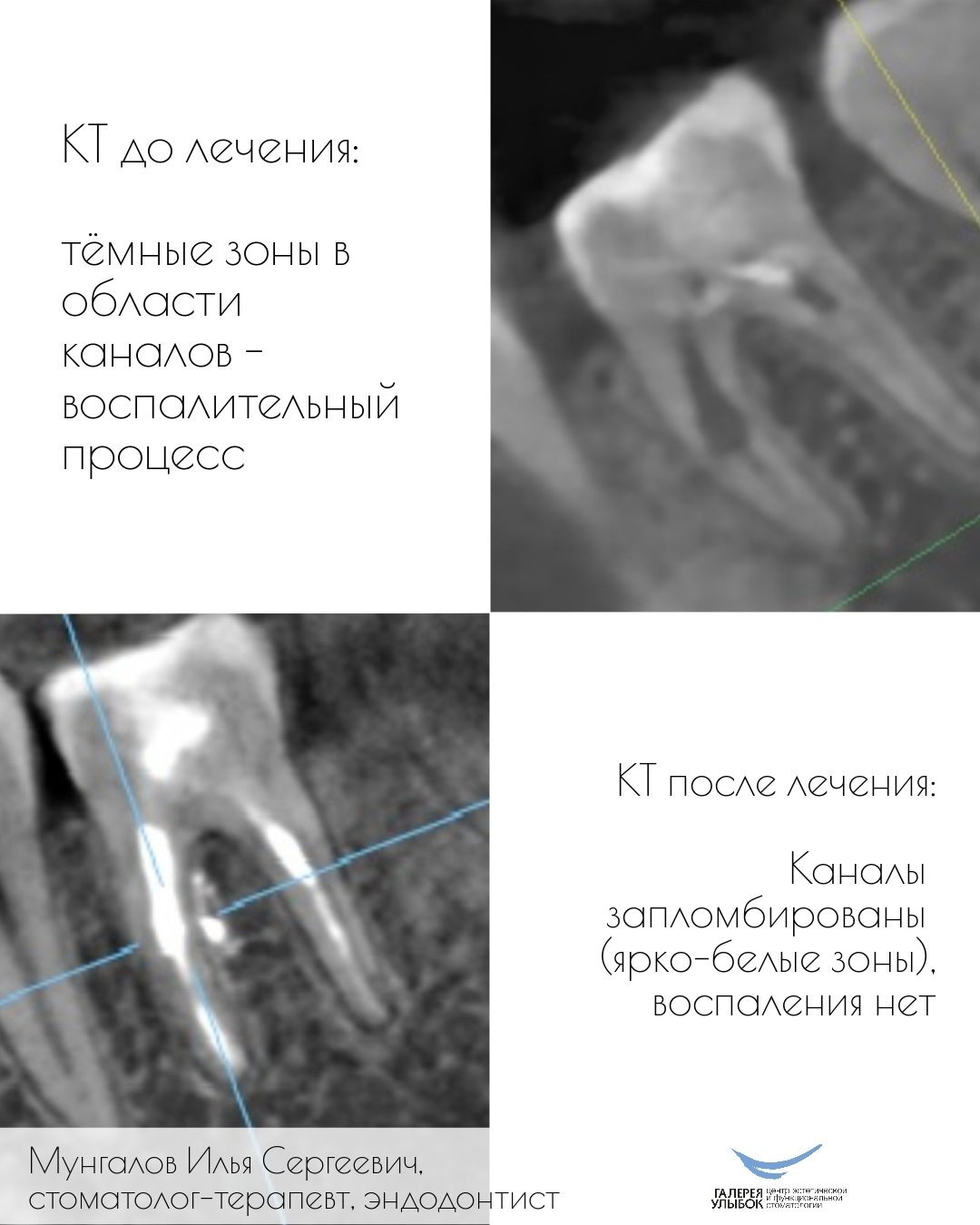 Сохранение зуба - Галерея улыбок